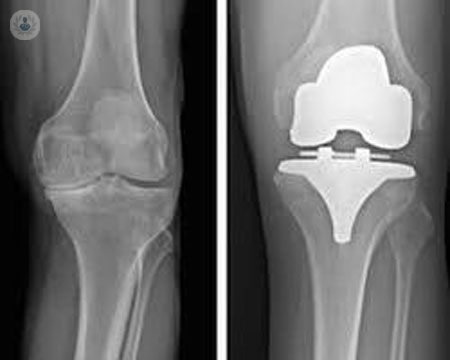 protesi-del-ginocchio-cosa-sapere immagine dell'articolo