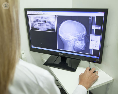 trattamenti-per-il-carcinoma-del-cavo-orale immagine dell'articolo
