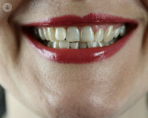 faccette-dentali-rispondiamo-ai-tuoi-dubbi immagine dell'articolo