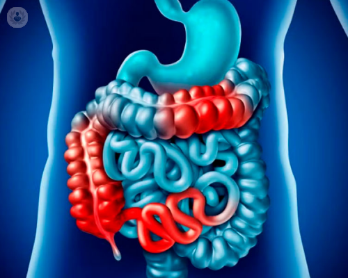 malattia-di-crohn-sintomi-e-i-segni-distintivi immagine dell'articolo