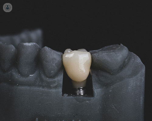 implantologia-dentale-i-consigli-del-dott-agostino-guida immagine dell'articolo