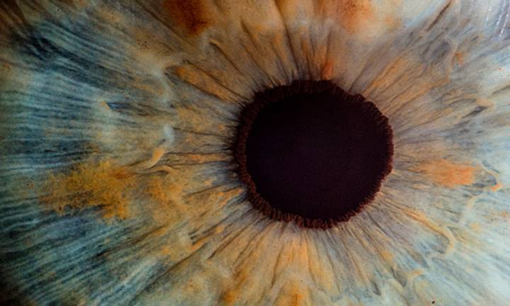 il-melanoma-oculare-trattamenti-e-prospettive immagine dell'articolo