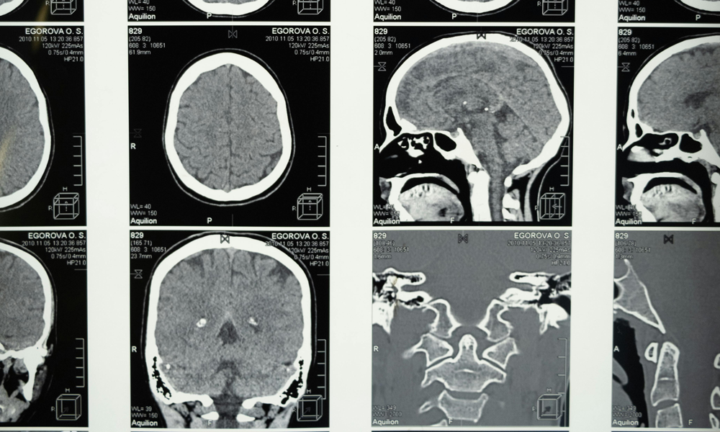 adenoma-ipofisario-cosa-causa-questo-tumore-benigno-e-come-trattarlo immagine dell'articolo