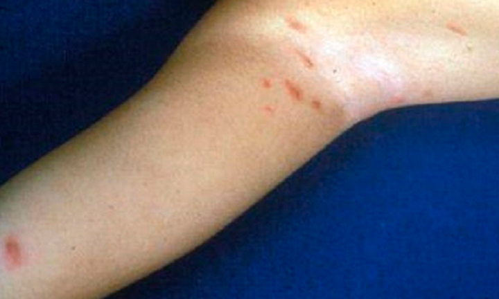 infestazione-da-sarcoptes-scabiei-un-approfondimento-con-il-dott-bonazzi immagine dell'articolo