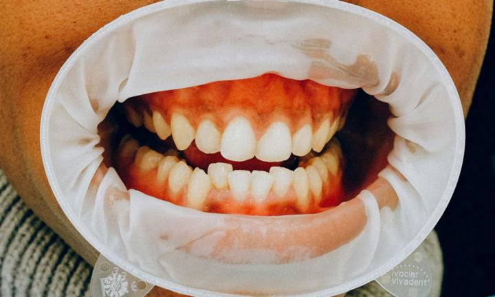 parodontite-tutto-quello-che-devi-sapere-per-proteggere-i-tuoi-denti immagine dell'articolo