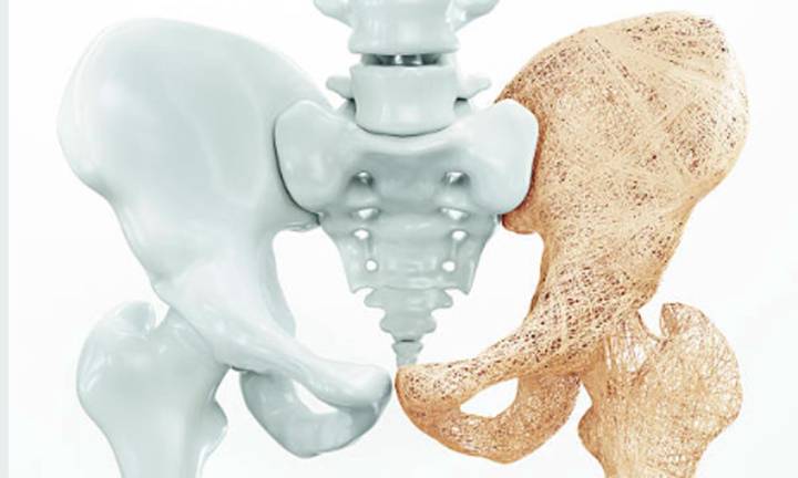 affrontare-l-osteoporosi-prevenzione-e-cure-efficaci immagine dell'articolo