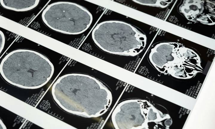 gamma-knife-per-meningioma-innovazione-ed-efficacia-del-trattamento-non-invasivo immagine dell'articolo