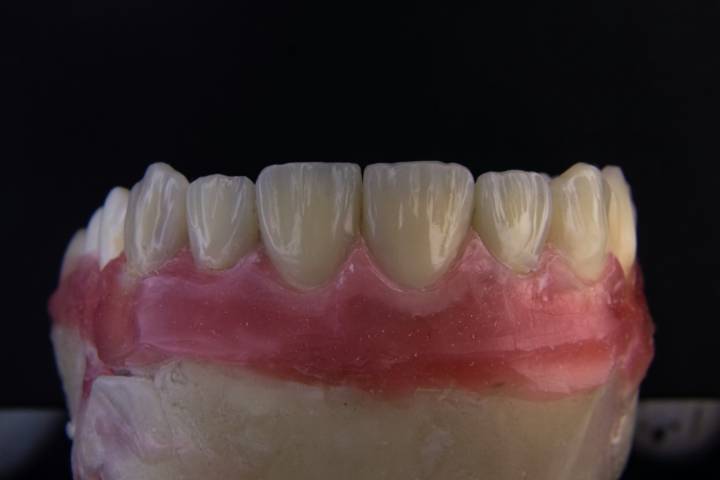 impianti-dentali-come-funzionano-e-comportamenti-da-evitare immagine dell'articolo
