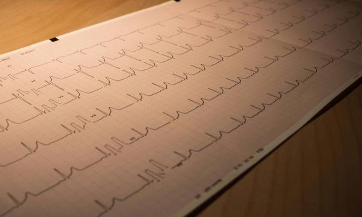 arteriosclerosi-aterosclerosi-differenze-cause-trattamenti immagine dell'articolo