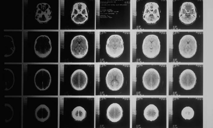tumore-cerebrale-tipologie-sintomi-diagnosi-trattamenti immagine dell'articolo
