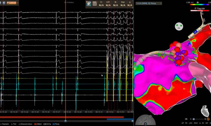 cardioneuroablazione-un-approccio-innovativo-per-la-bradicardia-e-le-aritmie immagine dell'articolo