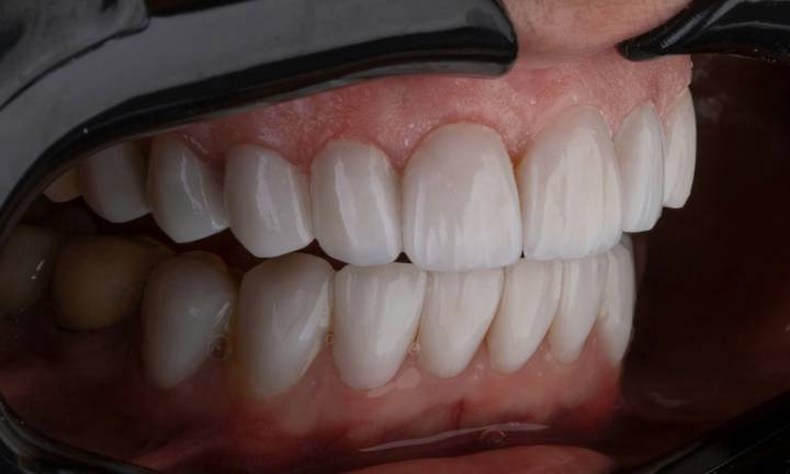 rinnova-il-tuo-sorriso-con-le-faccette-dentali-vantaggi-procedura-e-manutenzione immagine dell'articolo