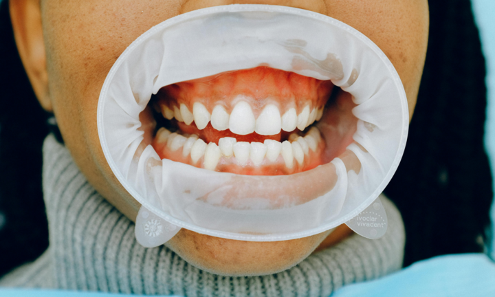 denti-sani-gengive-forti-tutto-quello-che-devi-sapere-sulla-parodontite immagine dell'articolo