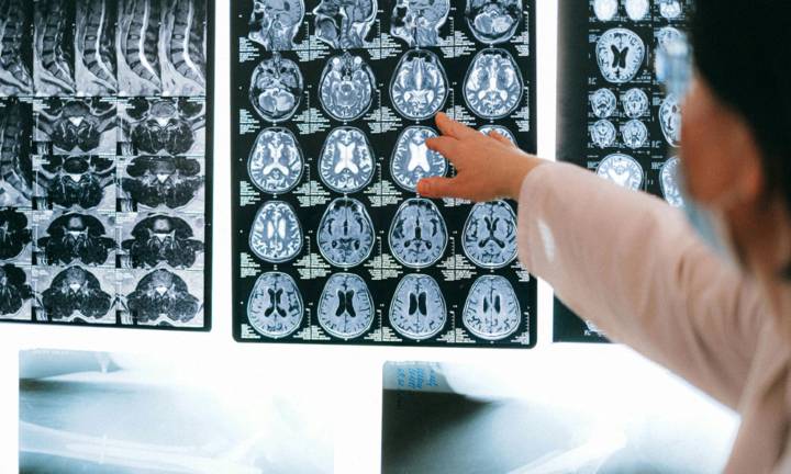 malformazione-di-chiari-cause-sintomi immagine dell'articolo