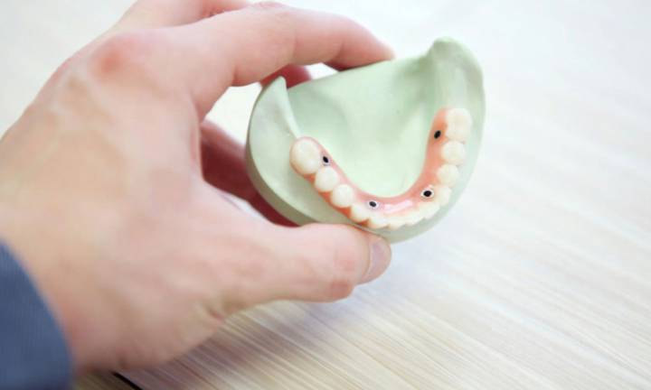 protesi-dentali-la-soluzione-ideale-per-tuo-sorriso immagine dell'articolo