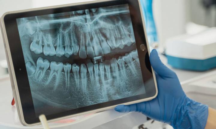 osteoporosi-denti-che-connessioni-esistono immagine dell'articolo