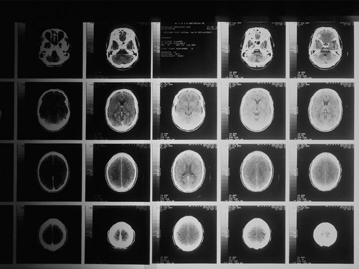 guida-completa-meningiomi-cranici-diagnosi-terapie immagine dell'articolo