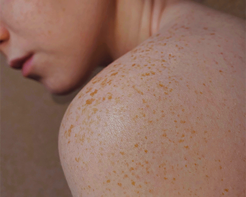 riconoscere-melanoma-guida-prevenzione-cura immagine dell'articolo