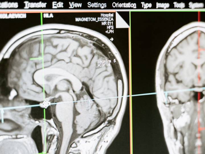 neuroradiologia-interventistica-cose-e-quando-rivolgersi-a-uno-specialista immagine dell'articolo