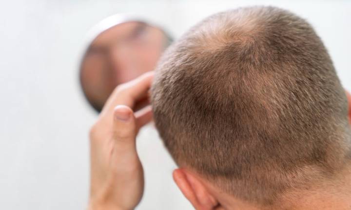 alopecia-le-terapie-del-futuro-per-contrastare-la-perdita-dei-capelli immagine dell'articolo