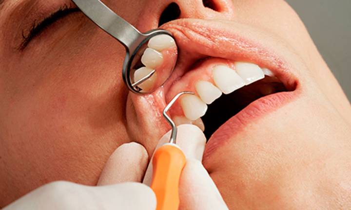 la-cura-della-parodontite-importanza-prevenzione immagine dell'articolo