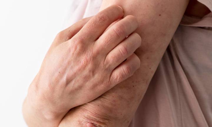 vivere-con-il-lupus-nuove-terapie-e-approcci-personalizzati-per-il-controllo-della-malattia immagine dell'articolo