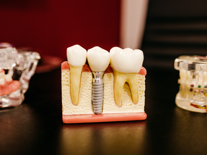 nuovi-sviluppi-implantologia-dentale-rivoluzione-sorriso immagine dell'articolo