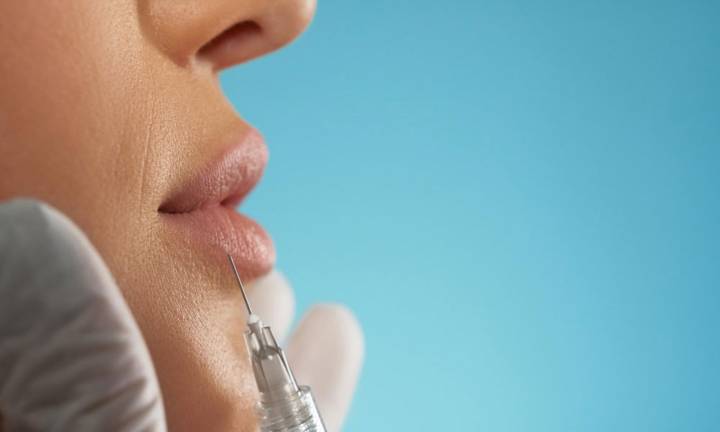 filler-labbra-volume-e-definizione-senza-chirurgia immagine dell'articolo