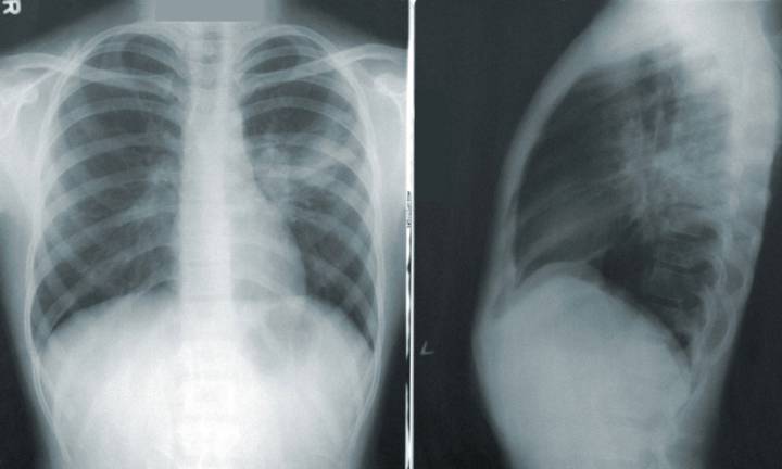 malattia-polmonare-ostruttiva-cronica-perche-viene-spesso-non-riconosciuta-in-pronto-soccorso immagine dell'articolo