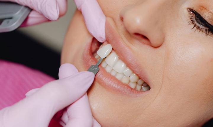 sorriso-nuovo-con-le-faccette-dentali-vantaggi-tempi-e-risultati- immagine dell'articolo