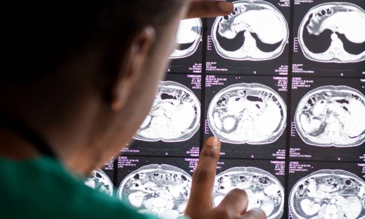 cosa-sono-i-prolattinomi-e-come-si-trattano-con-la-neurochirurgia immagine dell'articolo