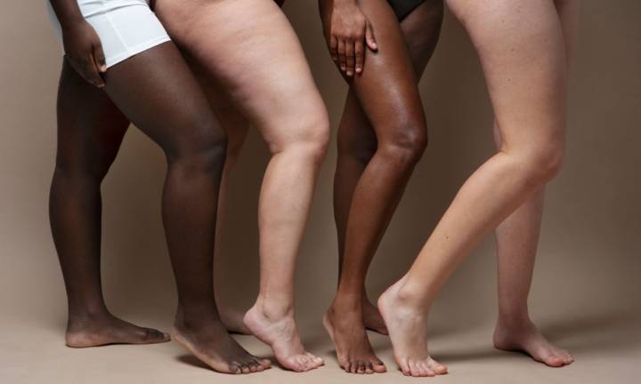 lipedema-quando-il-grasso-diventa-una-malattia immagine dell'articolo