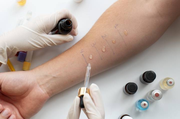 prick-test-chiave-diagnosticare-allergie immagine dell'articolo