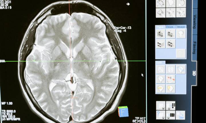 neurinoma-acustico-di-che-cosa-si-tratta immagine dell'articolo
