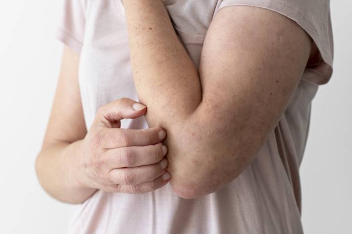 orticaria-i-segreti-per-comprenderla-e-trattarla-subito immagine dell'articolo