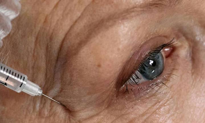 botox-cos-e-come-funziona-nella-chirurgia-estetica immagine dell'articolo