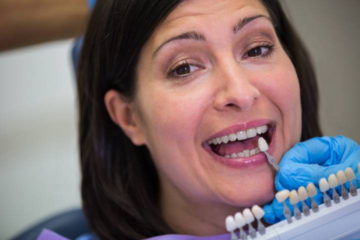 faccette-dentali-soluzione-estetica-funzionale-sorriso-perfetto immagine dell'articolo