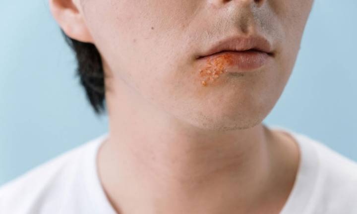 herpes-zoster-fuoco-sant-antonio- immagine dell'articolo