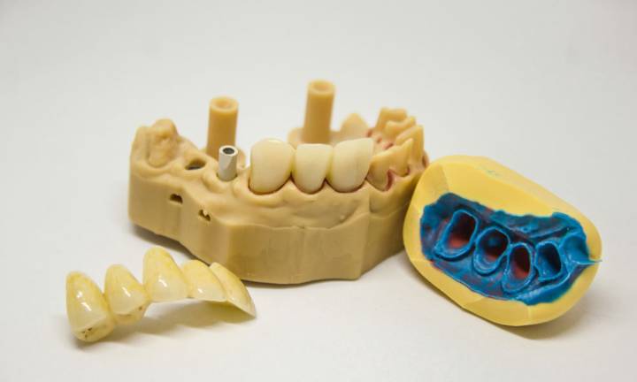protesi-dentali-quali-opzioni-sorriso-bello-sano immagine dell'articolo