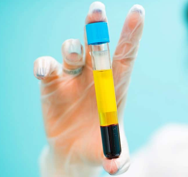 prp-personalizzato-trattamento-innovativo-lesioni-muscolari-tendinee-articolari immagine dell'articolo