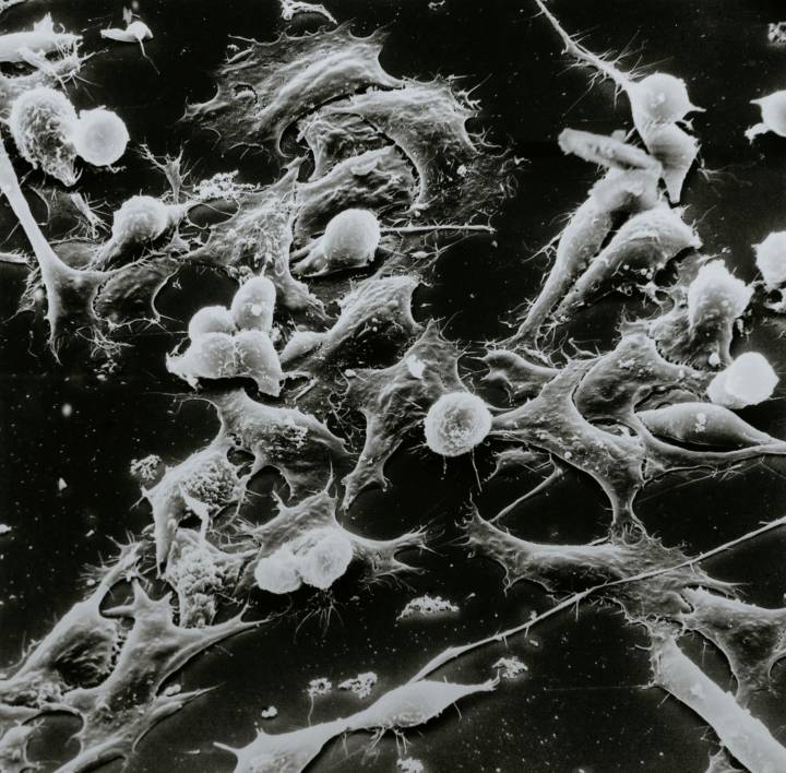 tumore-rene-sintomi-diagnosi-trattamenti-innovativi immagine dell'articolo