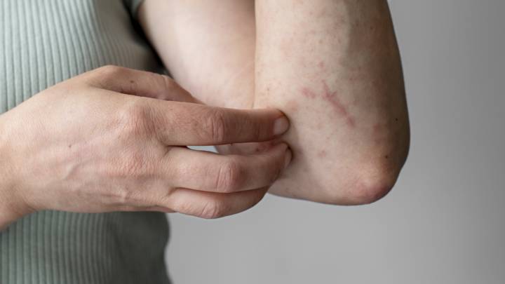 reazioni-cutanee-improvvise-orticaria-allergica immagine dell'articolo