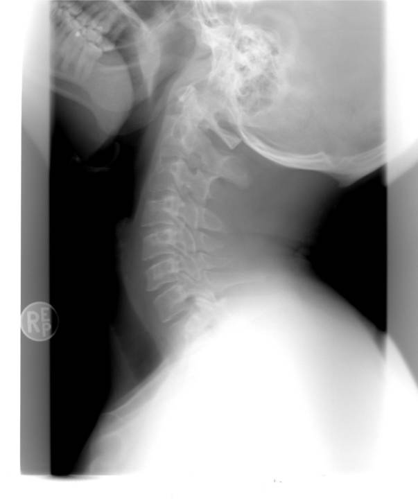 mielopatia-cervicale-diagnosi-cura- immagine dell'articolo