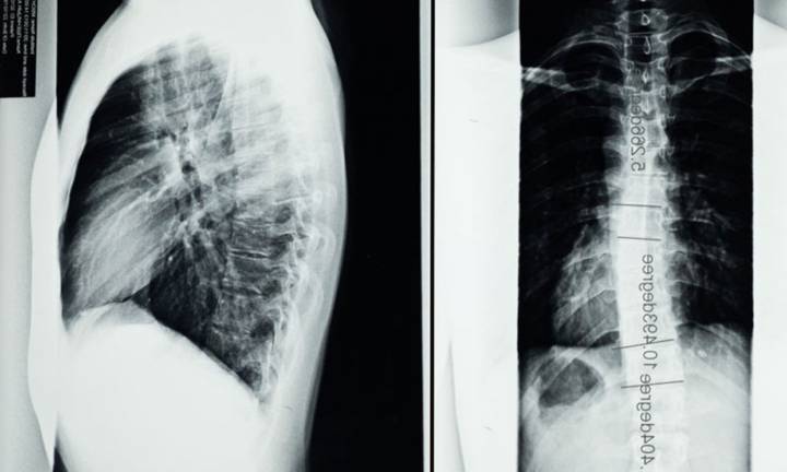 scoliosi-cause-diagnosi-trattamenti-moderni immagine dell'articolo