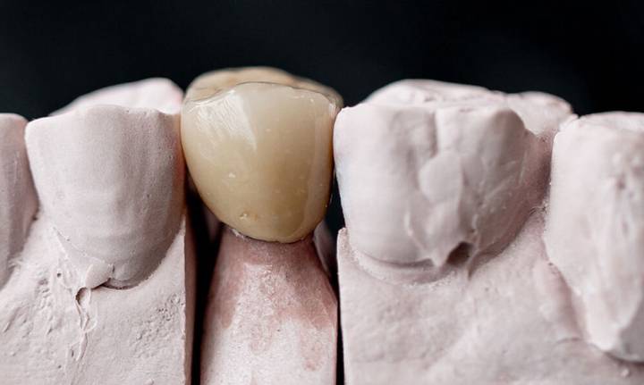 scegliere-colore-corona-dentale-consigli-esperto immagine dell'articolo