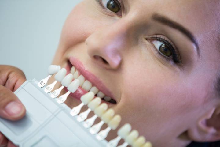 la-procedura-per-applicare-le-faccette-dentali-e-la-loro-durata immagine dell'articolo