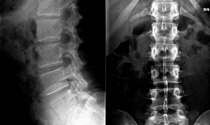 patologia-degenerativa-rachide immagine dell'articolo