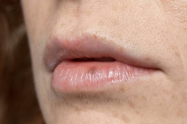 carcinoma-labbro-opzioni-chirurgiche-risultati-ricostruttivi immagine dell'articolo