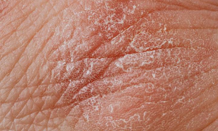 psoriasi-viso-zone-sensibili immagine dell'articolo