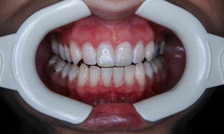 chirurgia-orale-lesioni-benigne-prevenzione-e-trattamento immagine dell'articolo